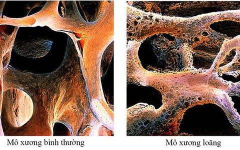 Loãng xương không chỉ là bệnh của tuổi già