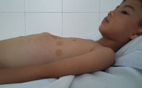 Bệnh Viện Đa Khoa Hoàn Mỹ Cửu Long thực hiện thành công can thiệp tim bẩm sinh