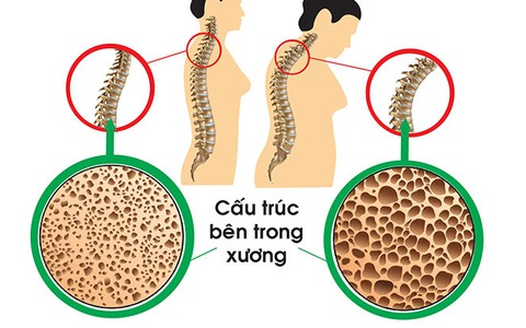 Biến chứng loãng xương có thể gây tàn tật suốt đời
