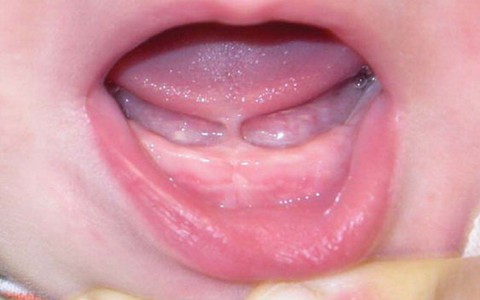 Blog bác sĩ: Nên cắt thắng lưỡi cho trẻ khi nào?
