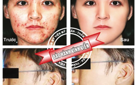 Điều trị mụn đột phá sau 3 ngày với công nghệ hàng đầu của Mỹ