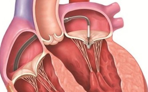 Không cần điều trị hở van tim hai lá 1/4