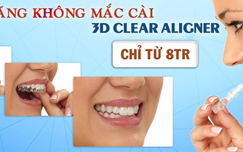 Niềng răng không mắc cài 3D Clear Aligner chỉ từ 8 triệu đồng