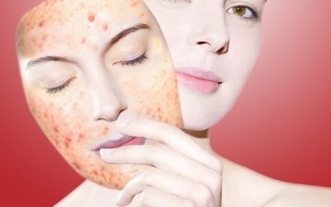 Điều trị mụn đột phá sau 3 ngày với công nghệ Nano hàng đầu của Mỹ