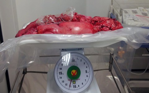 Cắt khối u nặng 13kg cho cụ bà 100 tuổi