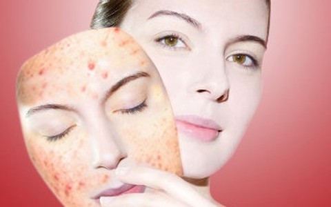 Điều trị mụn đột phá với công nghệ Nano hàng đầu của Mỹ