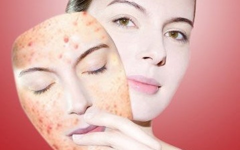 Điều trị mụn đột phá sau 3 ngày với công nghệ Nano hàng đầu của Mỹ