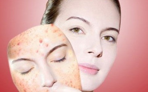 Điều trị mụn đột phá với công nghệ Nano hàng đầu của Mỹ