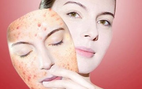 Điều trị mụn đột phá sau 3 ngày với công nghệ Nano hàng đầu của Mỹ