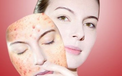 Điều trị mụn đột phá sau 3 ngày với công nghệ Nano hàng đầu của Mỹ