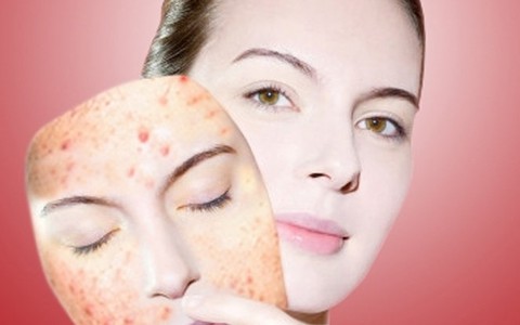 Điều trị mụn đột phá sau 3 ngày với công nghệ Nano hàng đầu của Mỹ