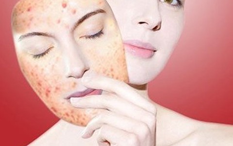 Điều trị mụn đột phá sau 3 ngày với công nghệ Nano hàng đầu của Mỹ