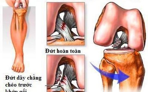 Đứt dây chằng chéo trước khớp gối: tổn thương thường bị bỏ sót