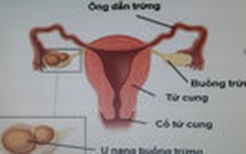 Bệnh viện "chẩn đoán viêm ruột thừa, mổ nang buồng trứng” khẳng định làm đúng