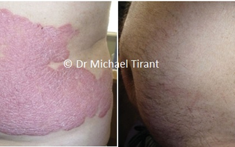 "Điều trị vảy nến bằng thảo dược, không corticoid"