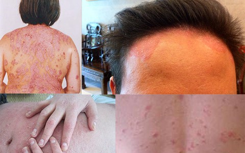 Cách điều trị bệnh vảy nến hiệu quả