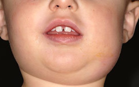 Chích ngừa rồi vẫn lây quai bị?