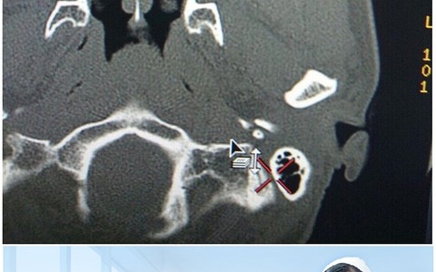 Phát hiện sớm ca U sàng hàm do nấm aspergillosis