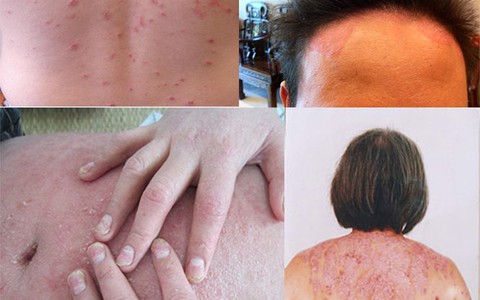 Cách điều trị bệnh vảy nến hiệu quả
