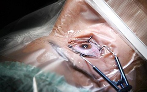 Nghiên cứu của Mỹ: hậu phẫu LASIK không hẳn hoàn hảo