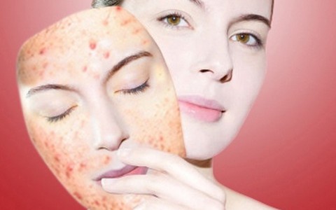 Điều trị mụn trong 3 ngày với công nghệ Nano hàng đầu của Mỹ
