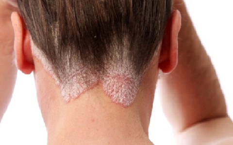 Điều trị sớm bệnh vẩy nến tránh nguy cơ biến chứng