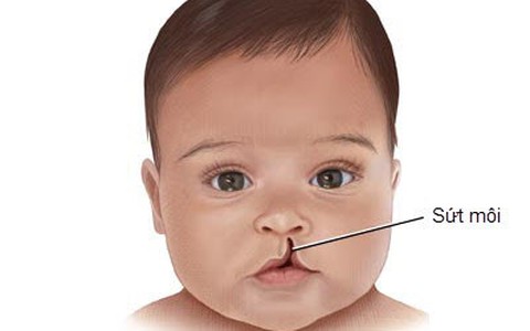 Mổ từ thiện cho trẻ em