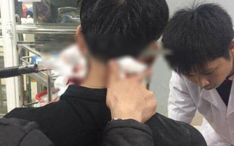 ​Cứu một thanh niên bị dao nhọn đâm xuyên gáy