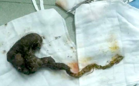 Hội chứng “công chúa tóc mây”, nhổ tóc và... ăn tóc
