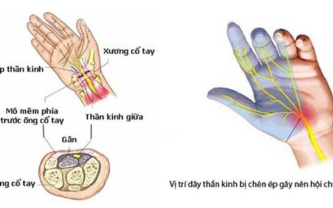 Hội chứng ống cổ tay – căn bệnh nhân viên văn phòng thường gặp