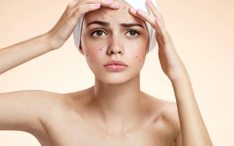 Chăm sóc da bị mụn trứng cá