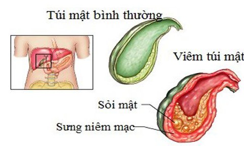 Phát hiện viêm túi mật cấp: chú ý dấu hiệu sớm