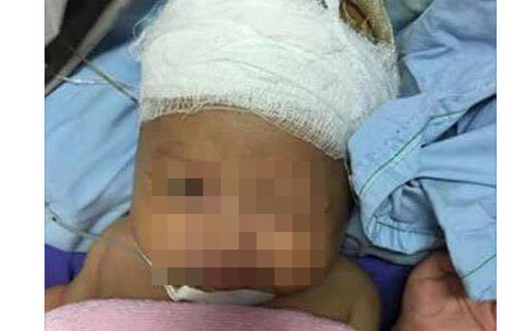 ​Bé 2 tuổi bị kéo nhọn đâm vào tai hơn 3cm