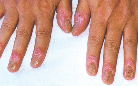 Nghiên cứu mới điều trị bệnh vảy nến móng