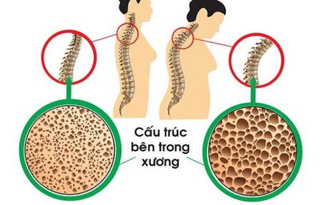 Nhiều nguy cơ dẫn đến loãng xương