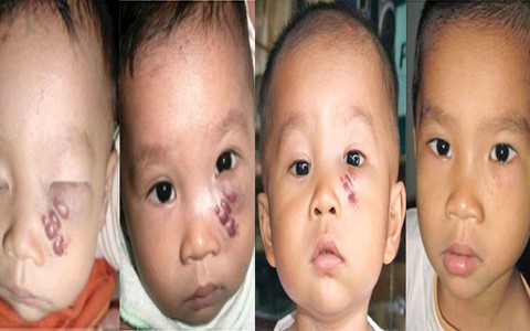 U máu, lành nhưng mệt