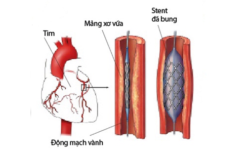 Dinh dưỡng và vận động sau đặt stent mạch vành