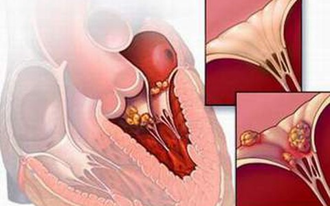 Đau tim từ... viêm họng