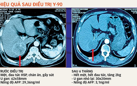Cấy hạt vi cầu phóng xạ để điều trị ung thư gan