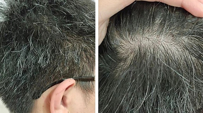 Tóc bạc sớm ở người trẻ, vì đâu nên nỗi? - Tuổi Trẻ Online