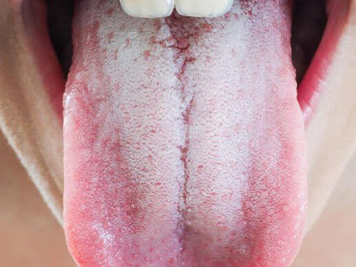 Lưỡi trắng có mối liên hệ gì với ung thư lưỡi? - Tuổi Trẻ Online