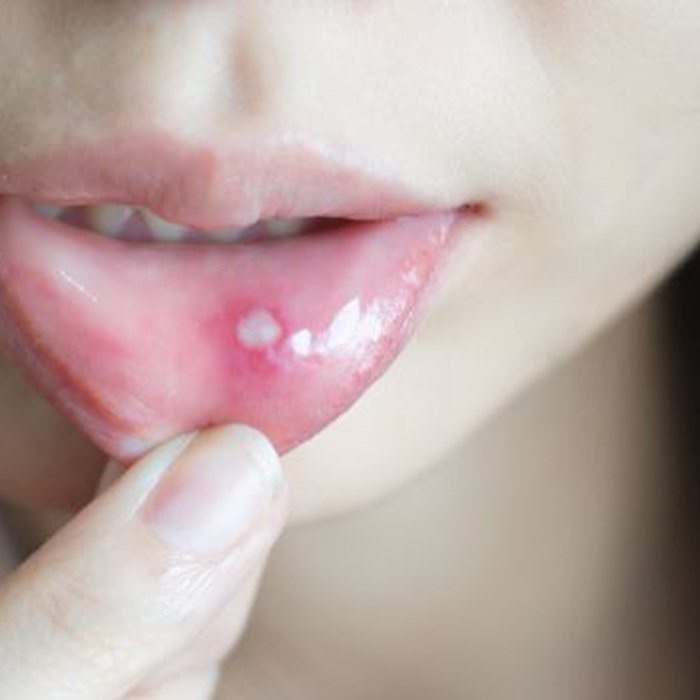 Bị nhiệt miệng không nên ăn gì