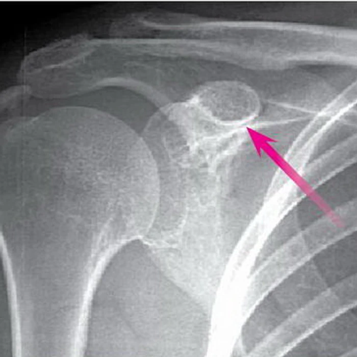 Đau vai chưa chắc do cột sống cổ - Tuổi Trẻ Online