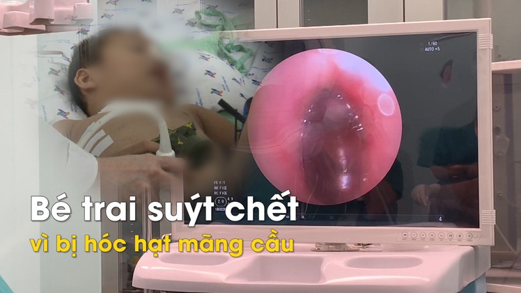 Bé trai 3 tuổi bị hóc hạt mãng cầu suýt chết