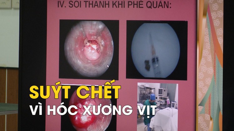 Suýt chết vì hóc xương vịt, bệnh viện lại chữa viêm phế quản