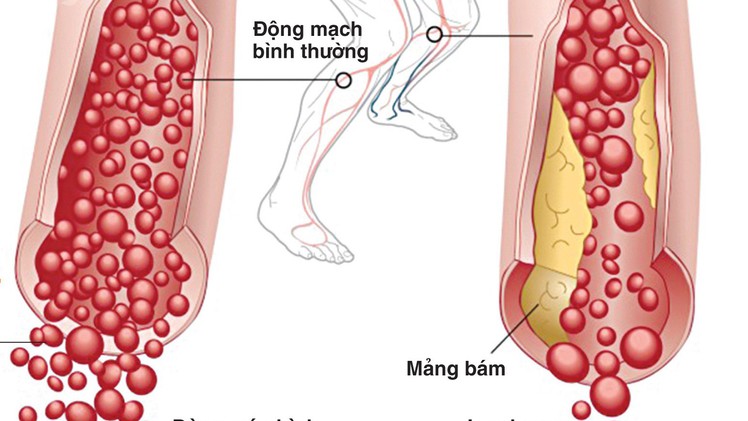 Nguy cơ đoạn chi do tắc động mạch chi dưới