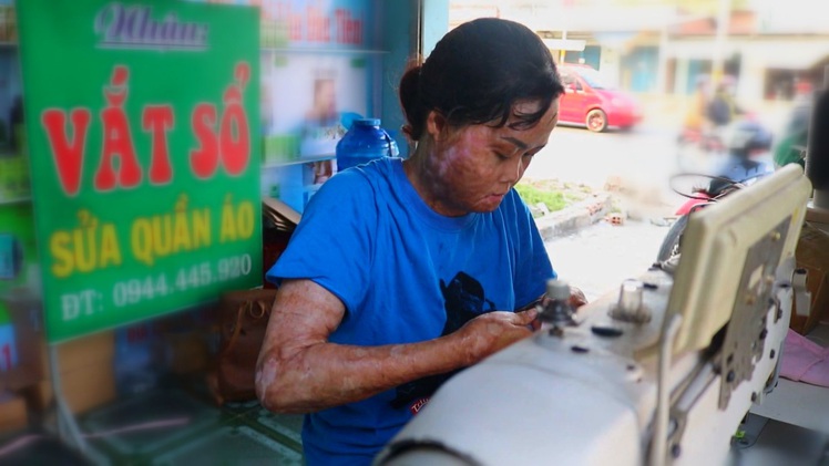 Góc nhìn trưa nay | Hành trình ‘hồi sinh’ của người vợ bị chồng tưới xăng thiêu sống