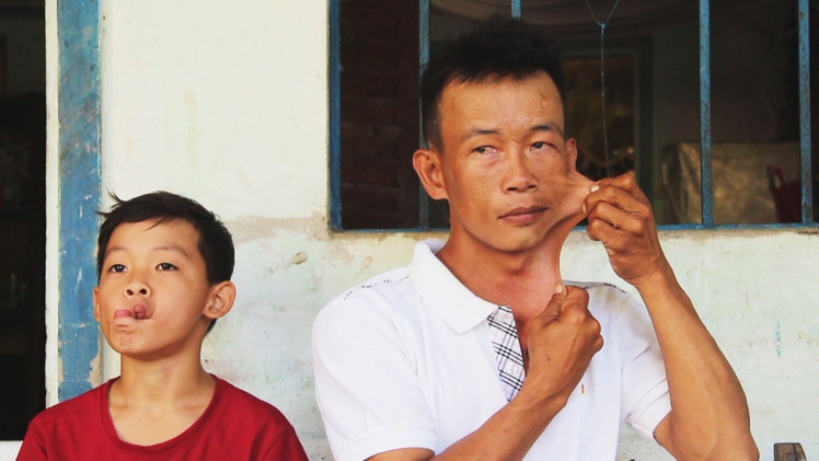 Góc nhìn trưa nay | Người đàn ông có làn da co giãn như cao su