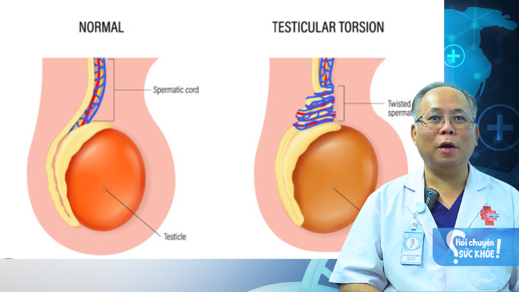 Xoắn dây tinh và thời gian vàng cấp cứu