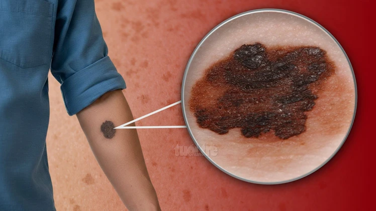 Chuyên gia chỉ cách nhận biết dấu hiệu ung thư da qua nốt ruồi